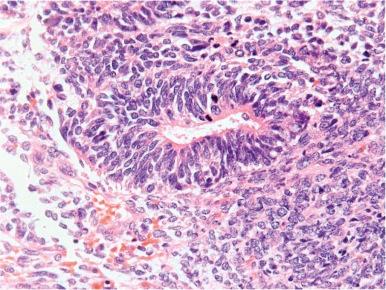 Figure 63-4, Immature teratoma.