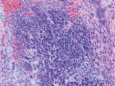 Figure 63-8, Embryonal carcinoma.