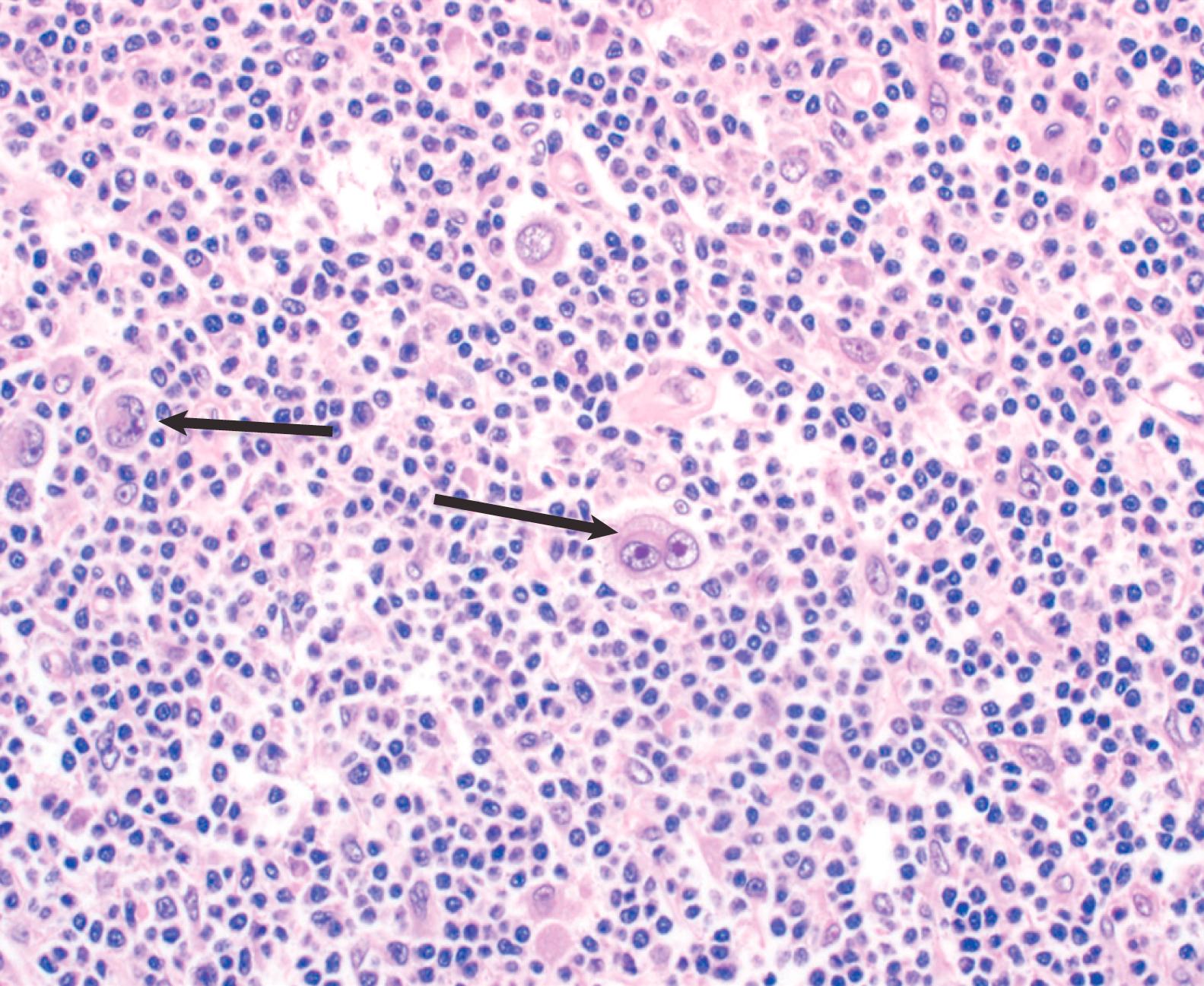 Fig. 26.1, Hodgkin lymphoma with diagnostic Reed-Sternberg cells (arrows). These cells are large compared with the surrounding infiltrate of nonneoplastic cells, and they have abundant, slightly basophilic cytoplasm and prominent nucleoli. The background contains an infiltrate of small nonneoplastic lymphocytes.