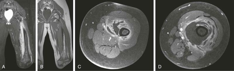 eFIGURE 68–1, STIR coronal MR image ( A ), T1-weighted coronal MR image ( B ), postcontrast T1-weighted, fat-saturated axial MR image ( C ), and postcontrast T1-weighted, fat-saturated axial MR image ( D ) in a 10-year-old boy with extensive abscess associated with osteomyelitis of the left femur. STIR, Short tau inversion recovery.