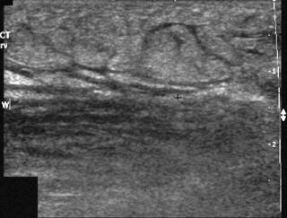 eFIGURE 68–2, Sonogram showing “cobblestone” appearance of the edematous subcutaneous soft tissues in a patient with cellulitis.