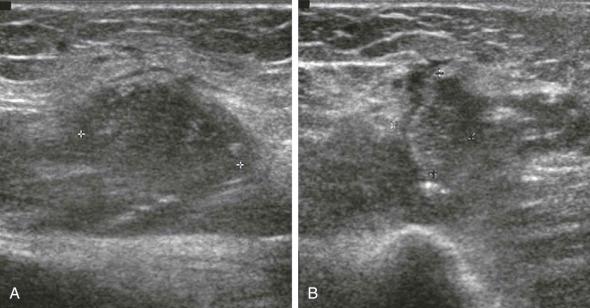 eFIGURE 68–3, A and B , Sonograms showing small abscess in the arm of a child with chronic osteomyelitis of the humerus after a fracture. The contents of the abscess are hypoechoic to the surrounding tissues with internal echoes.