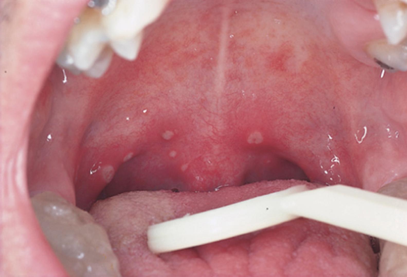 Fig. 22.1, Herpangina. Viral ulcer on the right tonsil consistent with coxsackievirus infection.