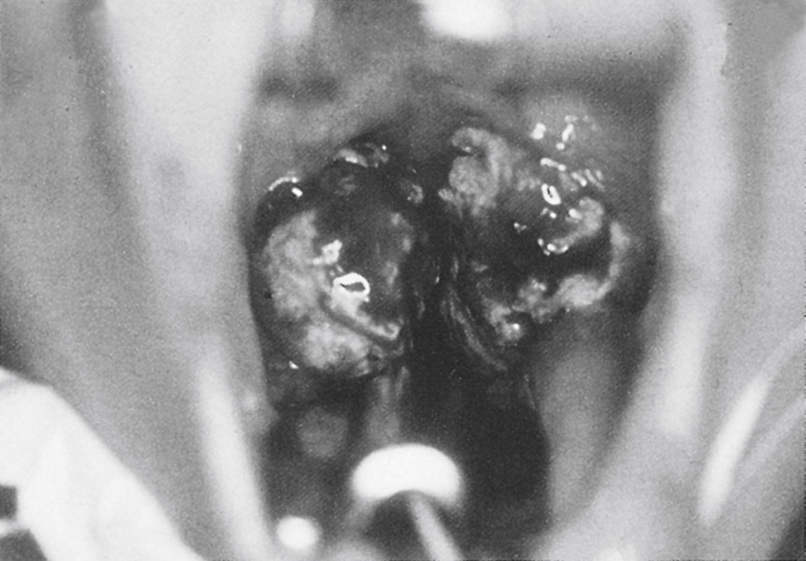 Fig. 22.2, Tonsillar hypertrophy in mononucleosis with significant airway obstruction.