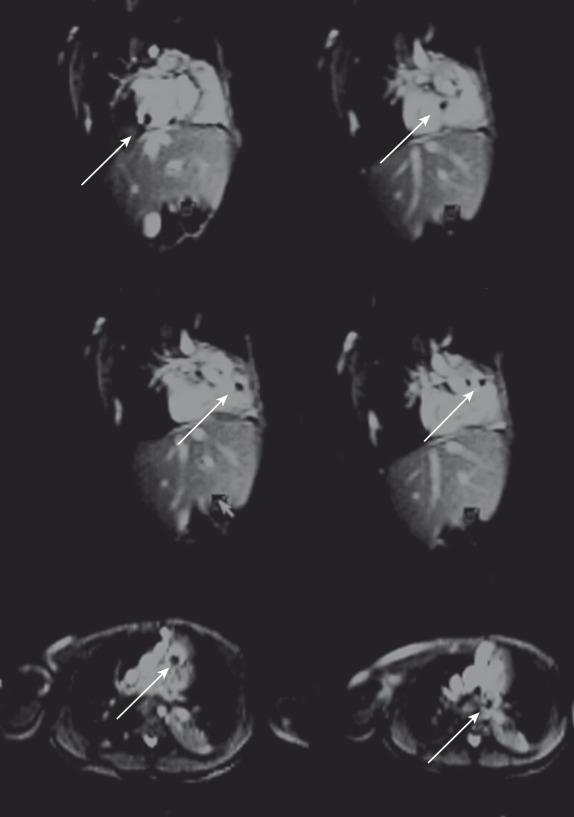 FIG. 48.3, Manipulation of carbon dioxide-filled balloon catheter (arrows) from the inferior vena cava to the right pulmonary artery using solely magnetic resonance guidance. Real-time interactive images: repetition time 2.9 ms, echo time 1.45 ms, flip angle 45 degrees, matrix 128 × 128, field of view 250 to 350, and temporal resolution 10 to 14 frames per second. Arrows show the signal void of the catheter tip as it traverses the inferior vena cava, right atrium, tricuspid valve, and right ventricular outflow tract and enters the pulmonary artery.