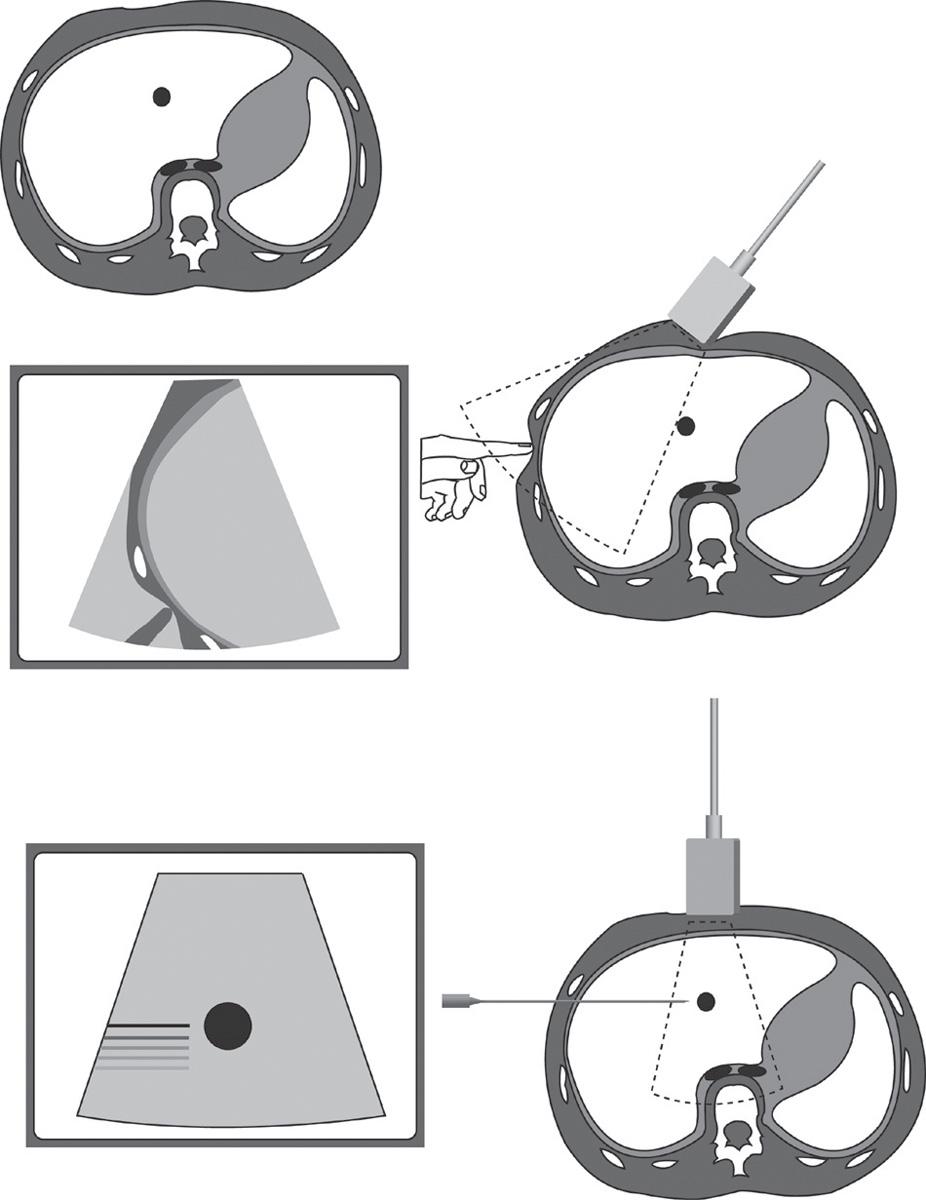 FIG. 56.3, Locating the Entry Site Laterally.