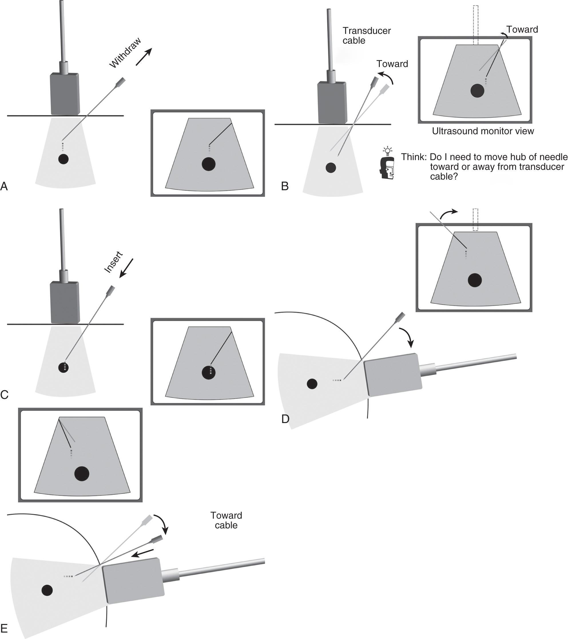 FIG. 56.7, Changing Needle Angulation.