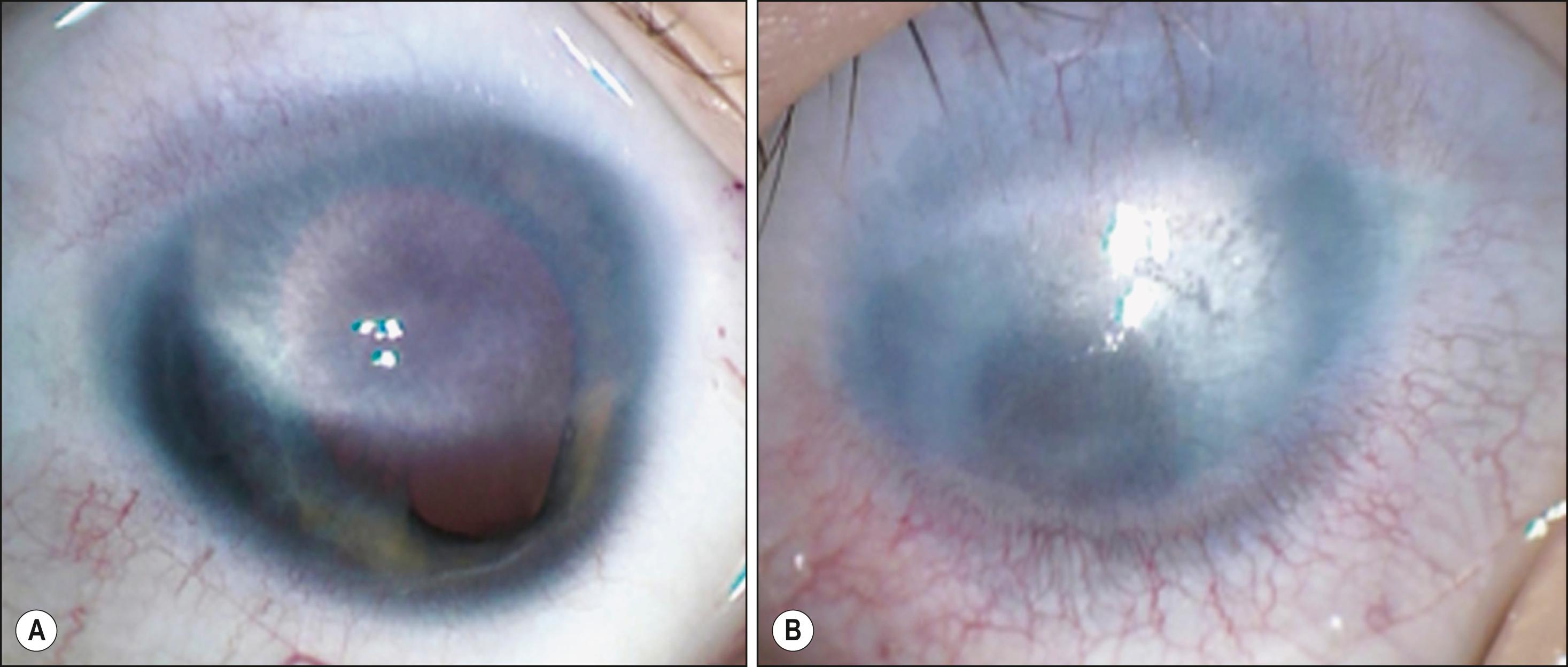 Fig. 124.2, The right eye of this child has partial corneal opacity for four-fifths of the upper cornea and a coloboma of the iris and retinochoroid ( A ); the lens has a partial cataract. This is the better eye. The left eye has a total corneal opacity ( B ). In this case, the better eye is likely to require intervention in the future, and so performing a unilateral penetrating keratoplasty in the left eye is an easier decision to make.