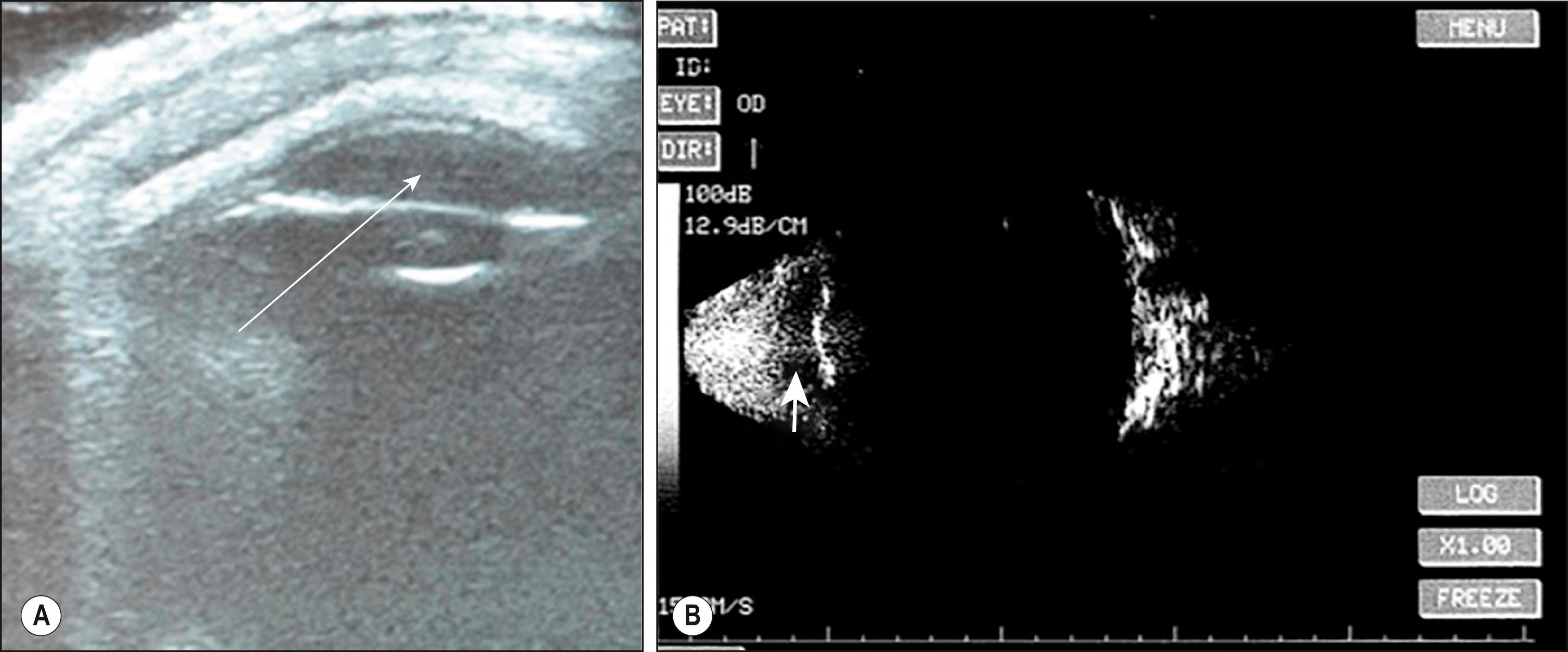 Fig. 124.3, Composite showing linear ultrasound of any eye with the anterior chamber clearly visible ( A , white thin arrow ) whereas the anterior chamber cannot be seen on the vector ultrasound ( B , thick white arrow ).