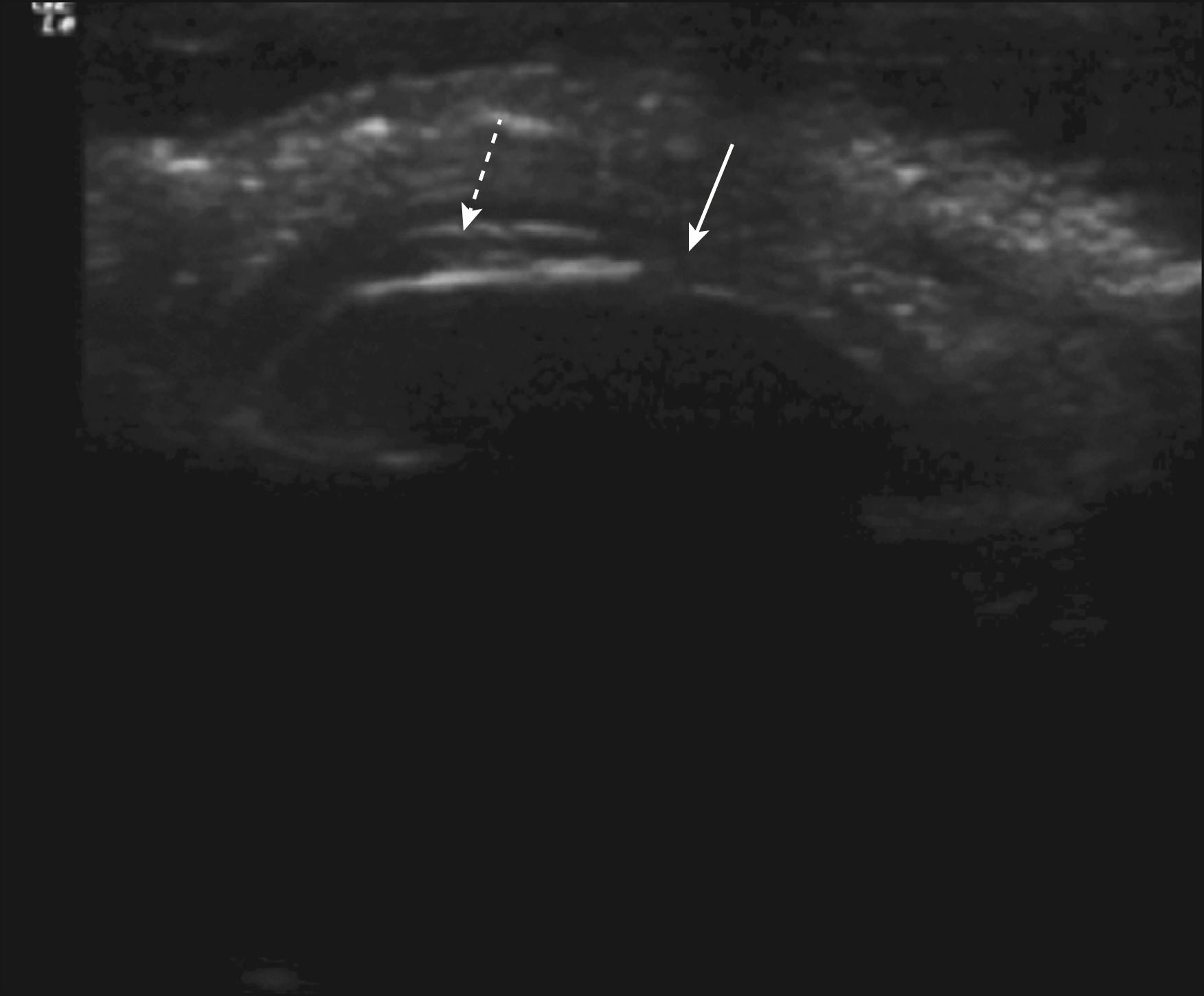 Fig. 124.6, Linear ultrasound probe used in clinic through closed lids to give an idea of possible keratolenticular adhesion (dashed arrow) and iridocorneal adhesion (solid arrow) in a child with Peters plus syndrome.