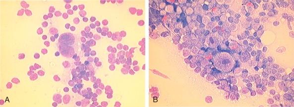 Figure 53-1, A, Reed-Sternberg cell. B, Hodgkin cell. Reed-Sternberg cells are large cells with abundant slightly basophilic cytoplasm and have at least two nuclear lobes or nuclei containing a prominent inclusion-like eosinophilic nucleolus. Mononuclear variants are known as Hodgkin cells and often have a more intense basophilic cytoplasm.