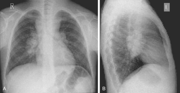 Figure 53-3, Chest x-ray of a patient with Hodgkin lymphoma and involvement of the mediastinal nodes and hilum.