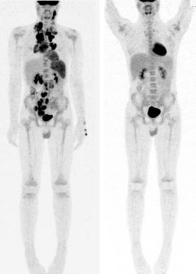 Figure 53-5, PET scan at diagnosis and after two cycles of ABVD-PC chemotherapy in an adolescent with advanced-stage Hodgkin lymphoma.