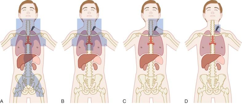 Figure 53-6, Radiation fields for treating Hodgkin lymphoma.