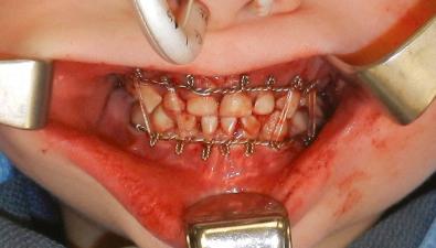 Fig. 2.5.3, Primary dentition in a 4-year-old patient with Risdon cables in place.