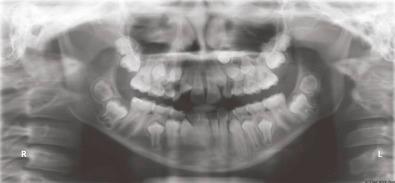 Fig. 2.5.4, Mixed dentition: panoramic image of mixed dentition (age 11) – note the eruption of permanent first molars and incisors. The developing canines and premolars (and second and third molars) have yet to erupt.