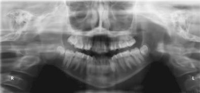 Fig. 2.5.5, Early permanent dentition (age 13) with developing third molars.