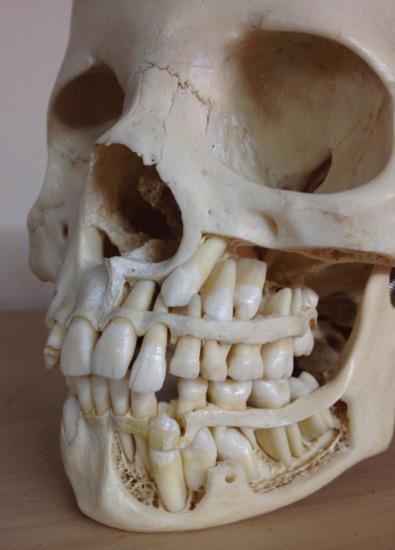 Fig. 2.4.3, The pediatric midface contains developing and erupting teeth which contribute to the strength of the maxilla. The transition into adult dentition and the development of the maxillary sinuses results in the predisposition for standard Le Fort fractures instead of dentoalveolar fractures.