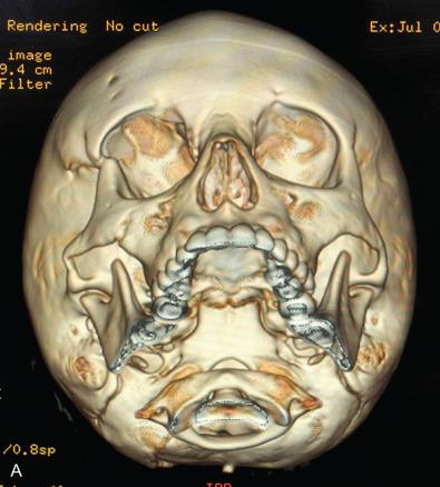 Fig. 2.4.4, An example of the unique nature of the elastic compliant pediatric craniofacial skeleton which can result in greenstick fractures and discontinuity between fracture zones in a 7-year-old female following an equestrian injury. A blow-in fracture of the right ZMC is associated with basal skull fractures extending into the right posterior fossa and occiput (A–B).