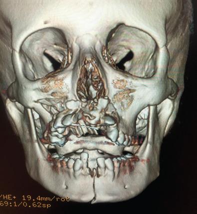 Fig. 2.4.5, Dentoalveolar fractures of the maxilla in association with a mandibular fracture in a 16-year-old female. CT (A) and panorex are useful to assess the extent of the injuries and determine the presence of tooth fractures.