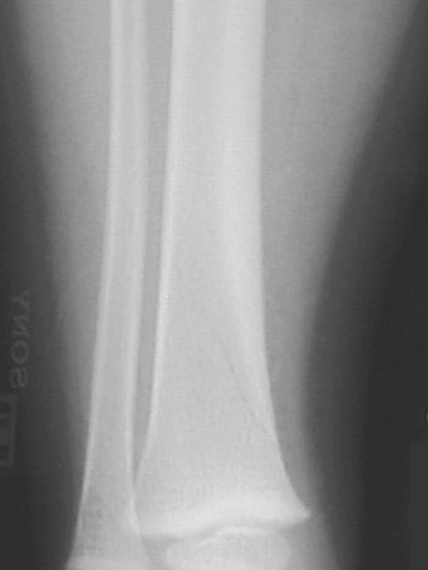 Fig. 170.20, Toddler’s fracture.