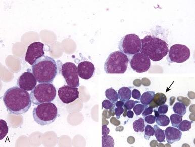 Figure 51-5, Subtypes of acute myeloid leukemia.