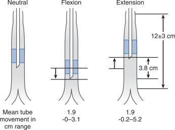 Fig. 20.5, Effect of head flexion and extension on endotracheal tube position. Note that flexion of the neck causes the endotracheal tube to migrate toward a mainstem bronchus, while neck extension can lead to dislodgement of the endotracheal tube from the trachea.