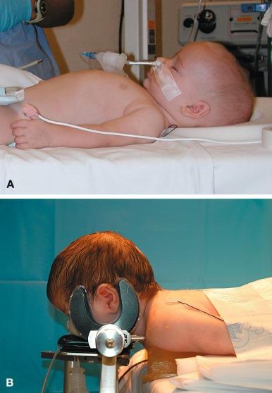 Fig. 20.7, Supine (A) and prone (B) positioning for an infant. Note that the infant’s head lies at a higher plane than the rest of the body. This feature increases the likelihood of venous air embolism during craniotomy.