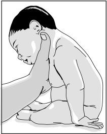 Fig. 27.2, Erb palsy in a newborn. The limb is adducted and internally rotated.