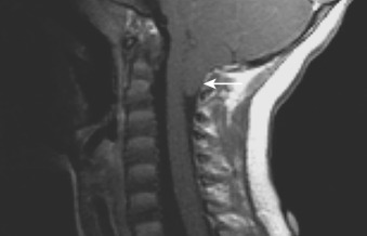 Figure 89-2, Chiari I malformation on MRI. Sagittal T1-weighted MR image through craniocervical junction shows inferior displacement of cerebellar tonsils ( arrow ) below level of foramen magnum.