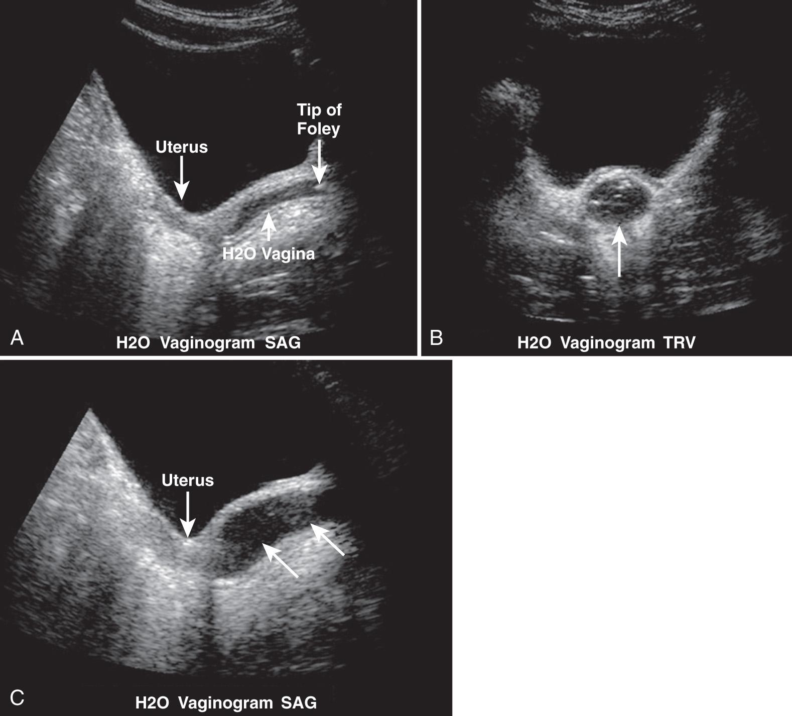 FIG. 54.1, Normal Hydrosonovaginography in Prepubertal Female With Prior Vaginal Rhabdomyosarcoma.