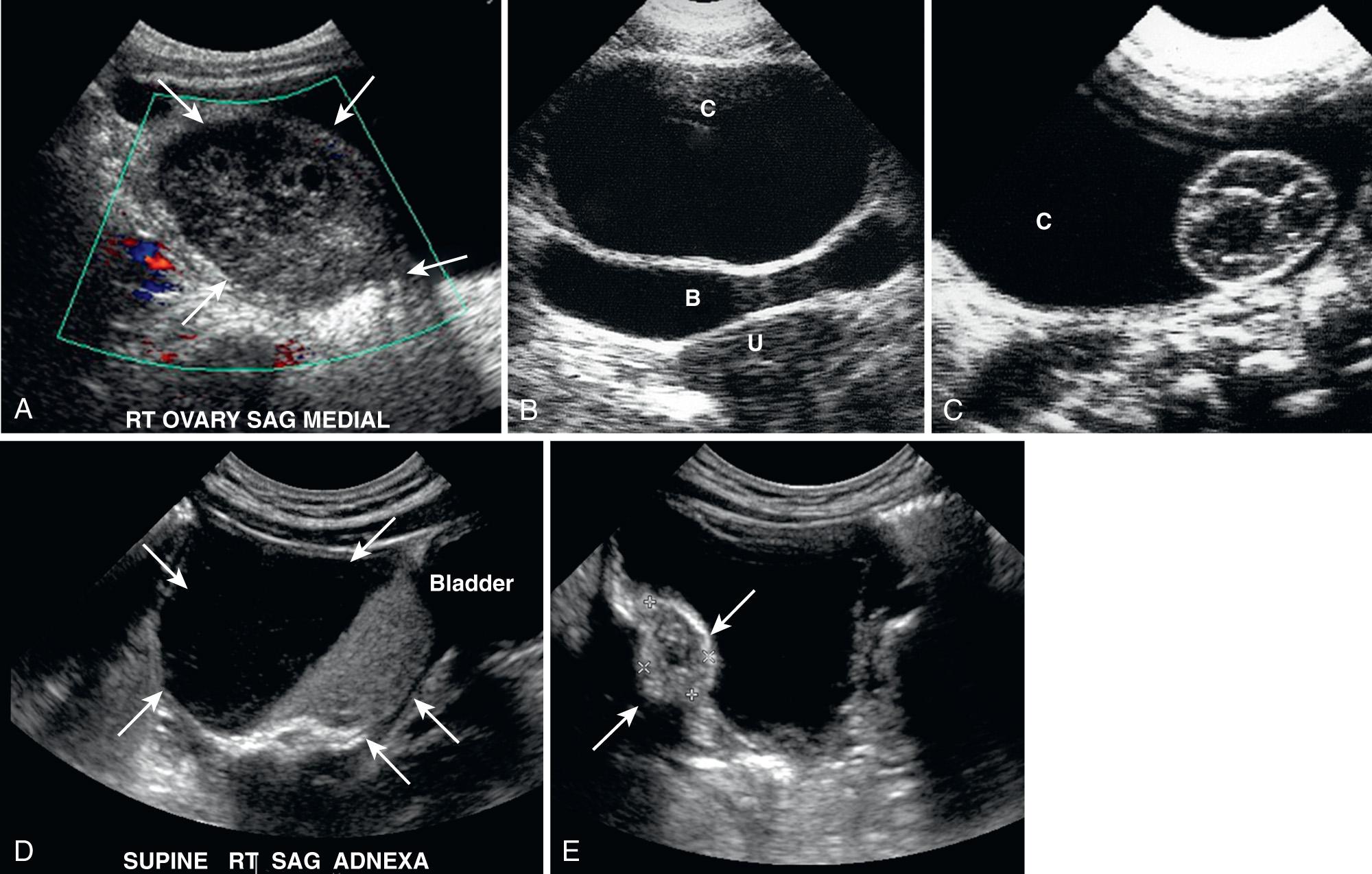 FIG. 54.11, Ovarian Torsion.