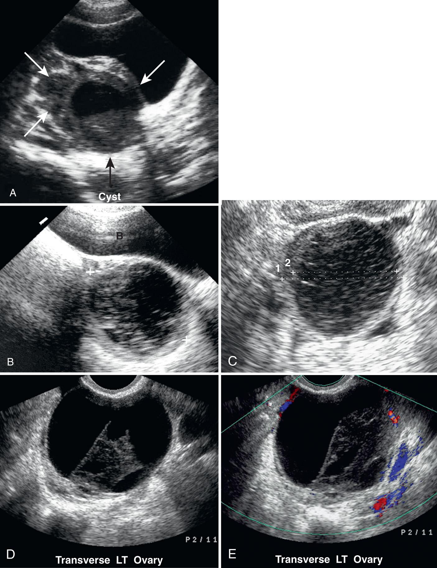 FIG. 54.12, Hemorrhagic Ovarian Cysts in Four Teenagers With Left Pelvic Pain: Spectrum of Appearances.