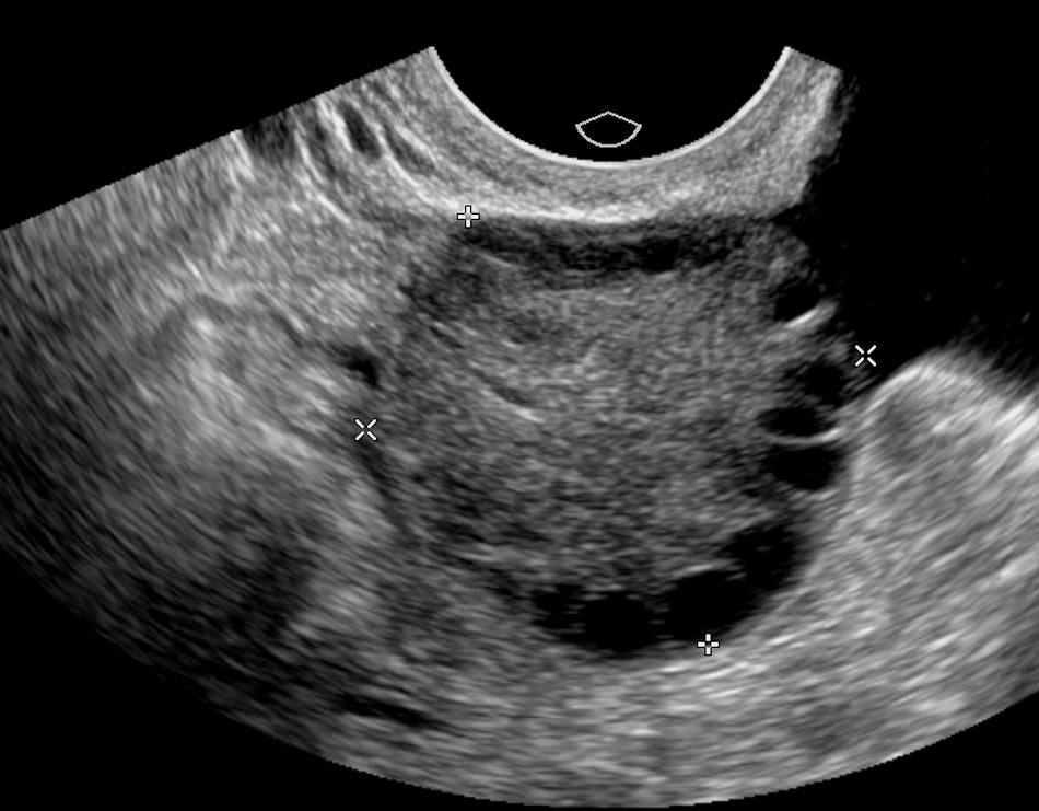 FIG. 54.14, Polycystic Ovarian Disease: Stein-Leventhal Syndrome.