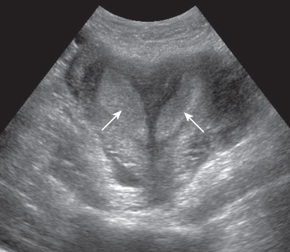 FIG. 54.17, Bicornuate Uterus.