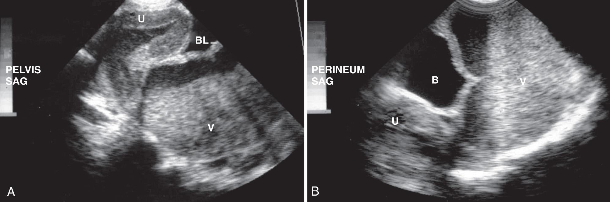 FIG. 54.19, Hematometrocolpos.