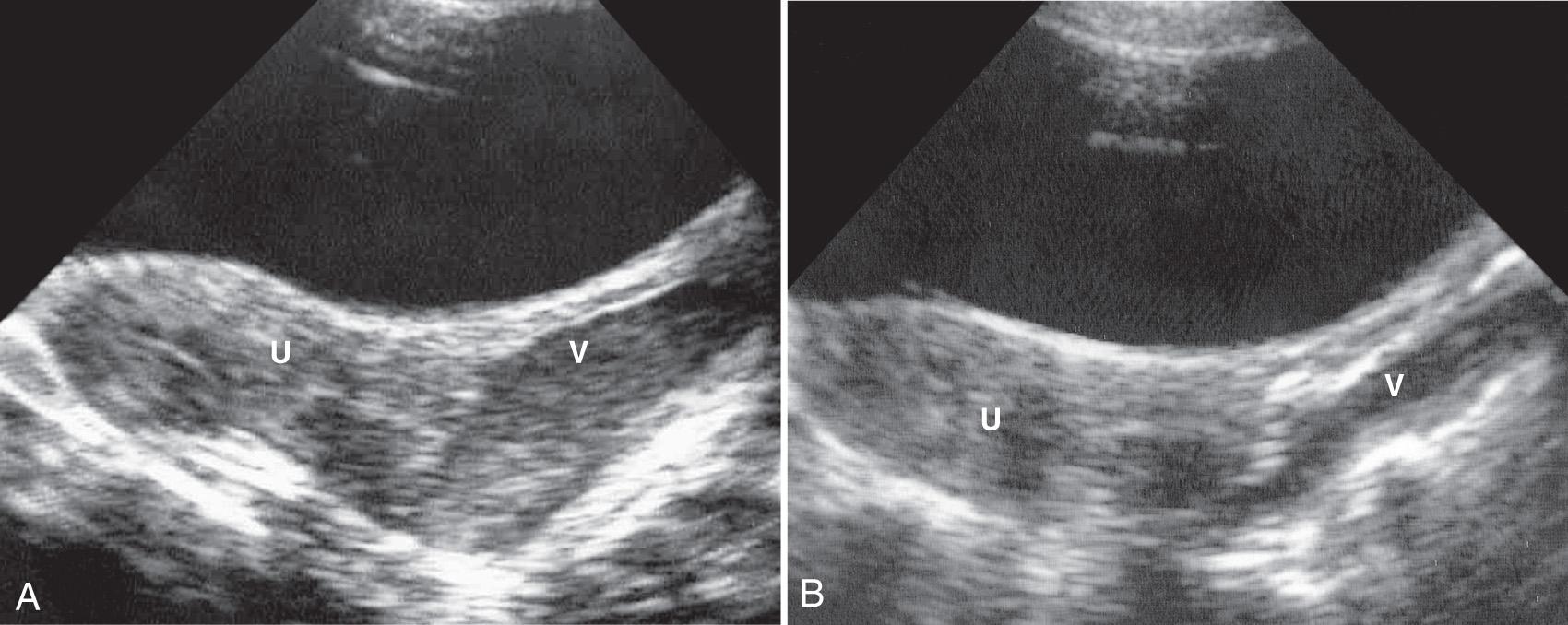 FIG. 54.20, Mayer-Rokitansky-Kuster-Hauser Syndrome.