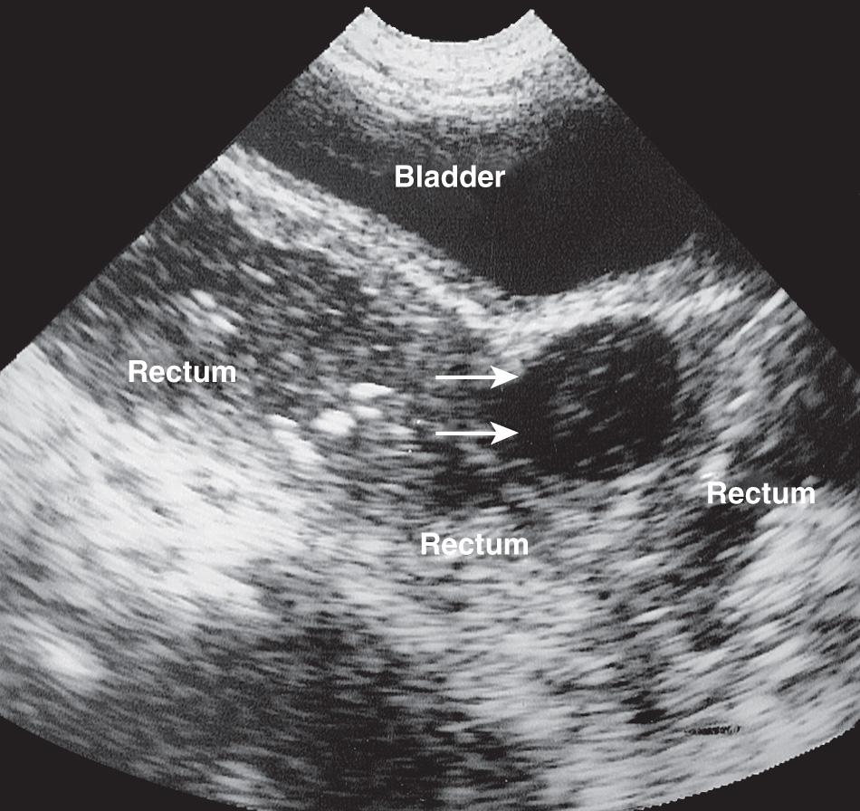 FIG. 54.2, Water Enema Technique in 5-Year-Old Boy With Appendiceal Abscess.