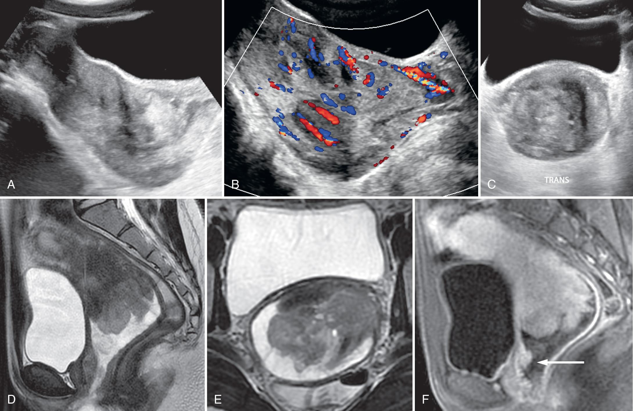 FIG. 54.21, Rhabdomyosarcoma of Vagina.