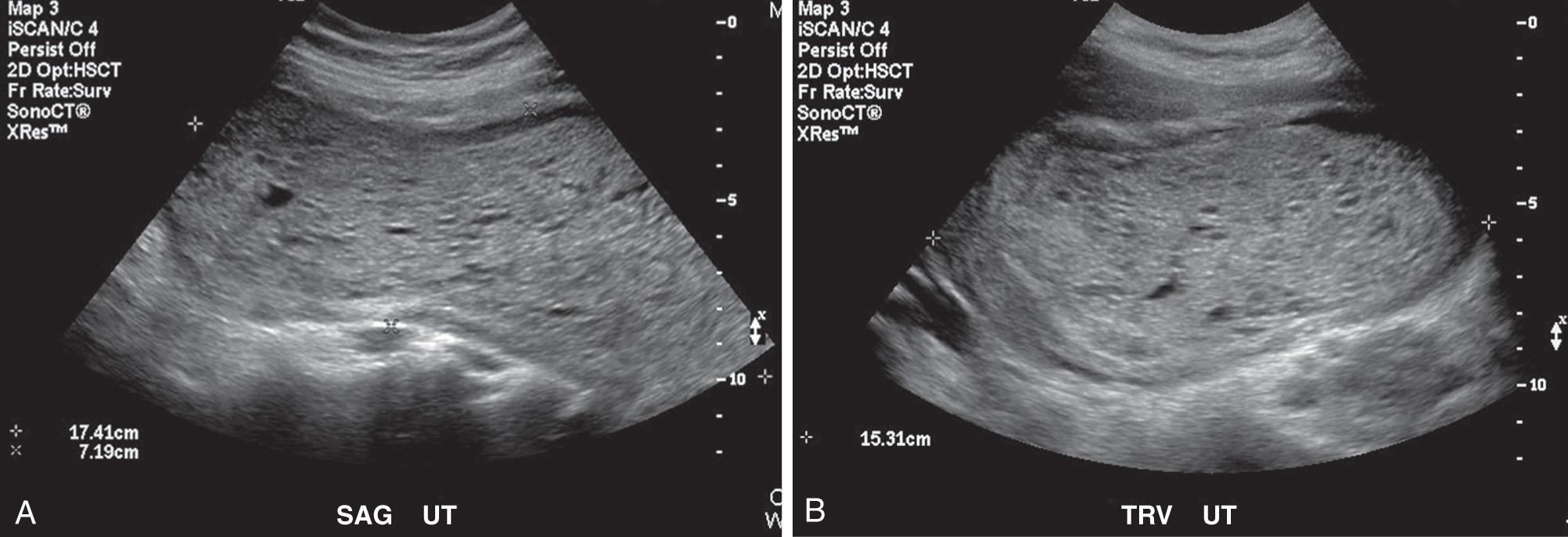 FIG. 54.22, Molar Pregnancy in 20-Year-Old Patient With Vaginal Bleeding and Abdominal Pain.