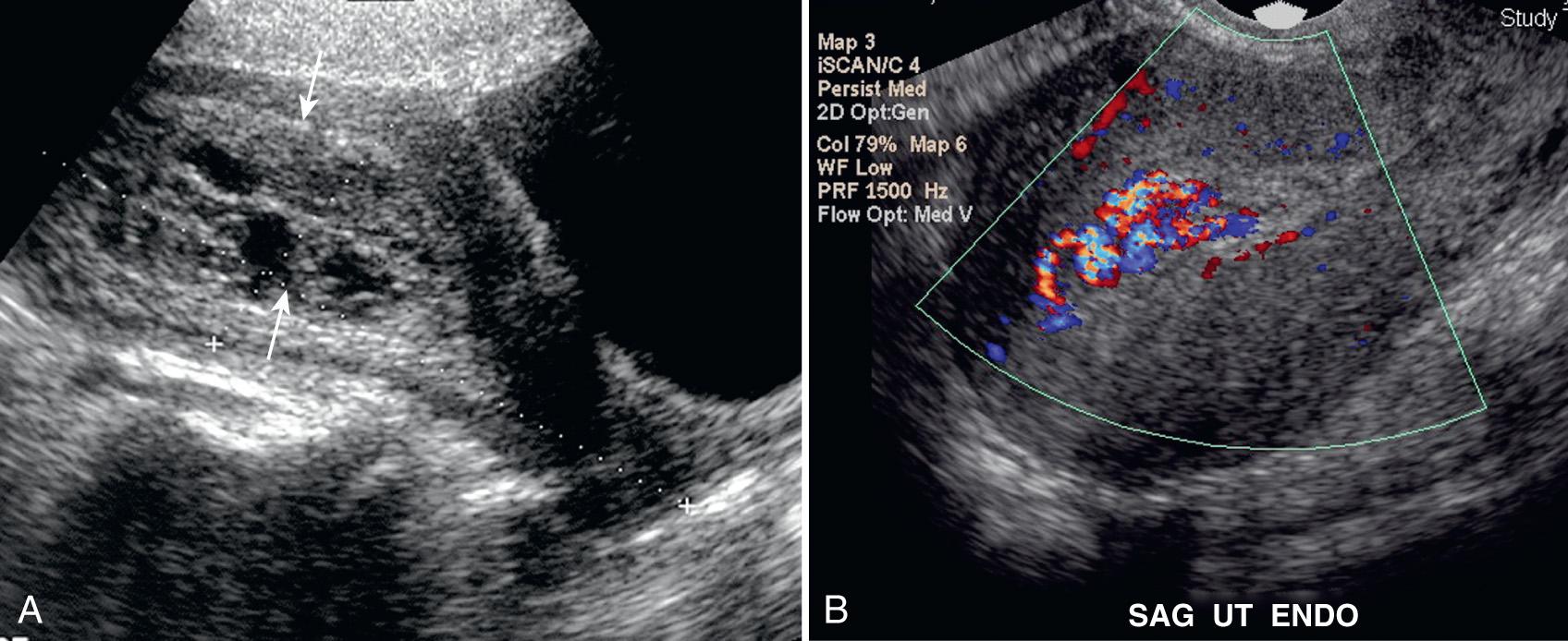 FIG. 54.23, Retained Products of Conception.