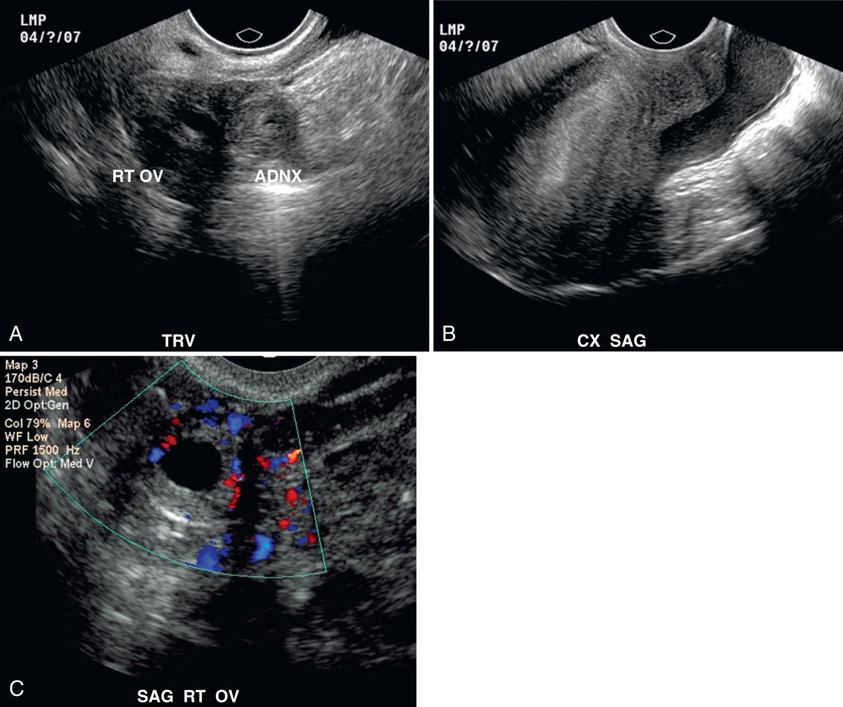 FIG. 54.24, Ectopic Pregnancy in Young Woman With Pelvic Pain and Vaginal Bleeding.