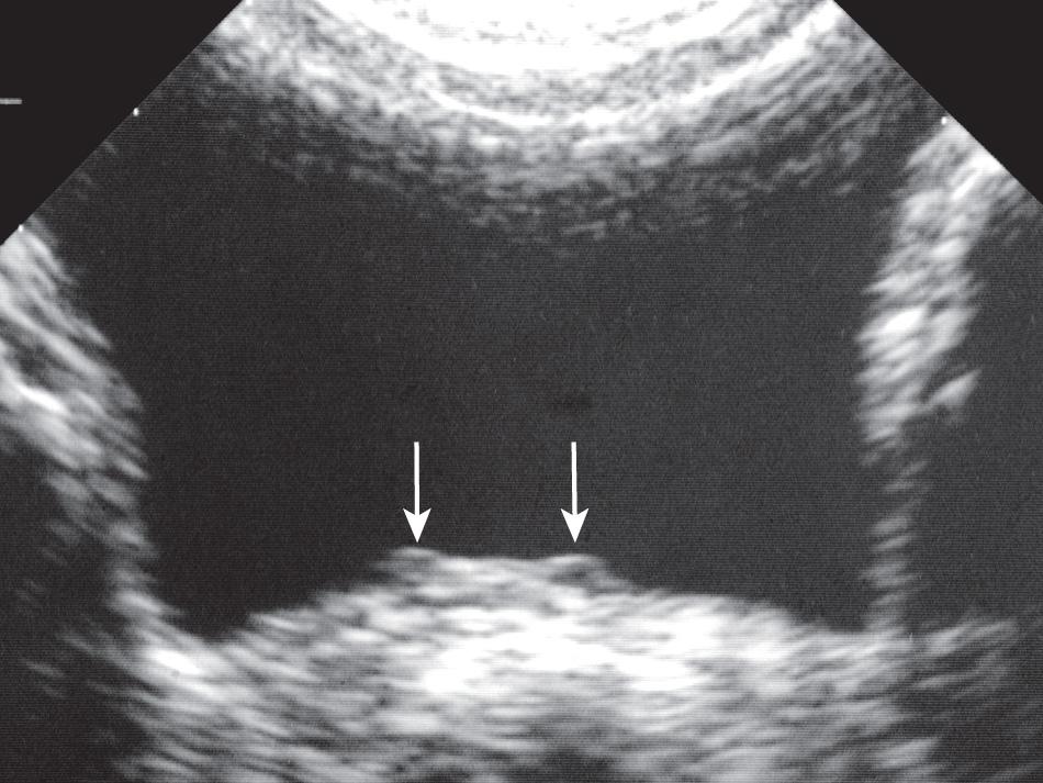 FIG. 54.3, Normal Trigone.