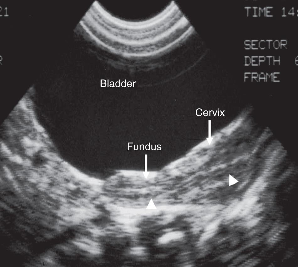 FIG. 54.5, Normal Newborn Uterus.