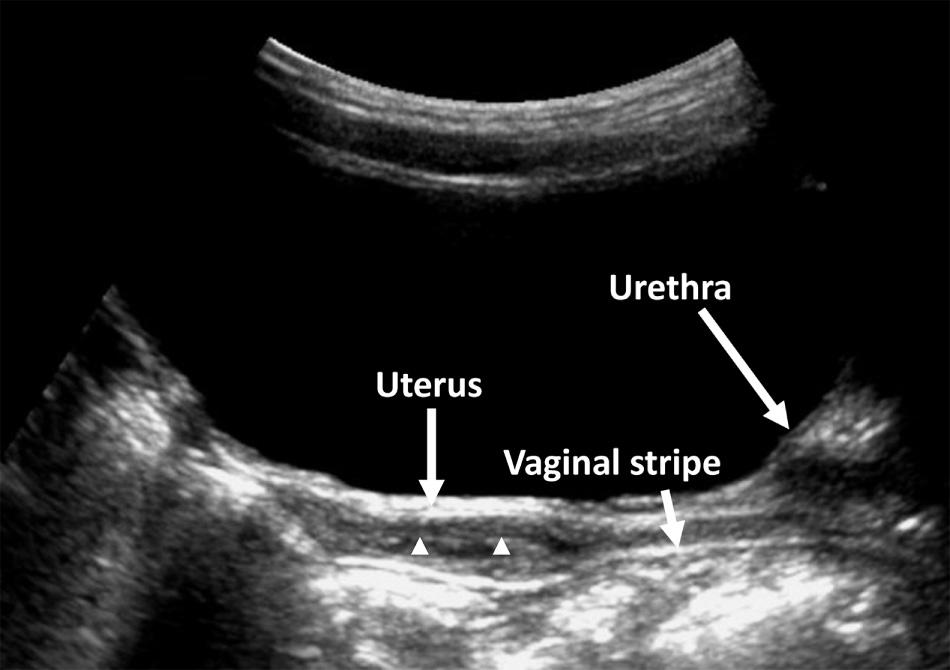 FIG. 54.6, Normal Prepubertal Uterus in 2-Year-Old Girl.