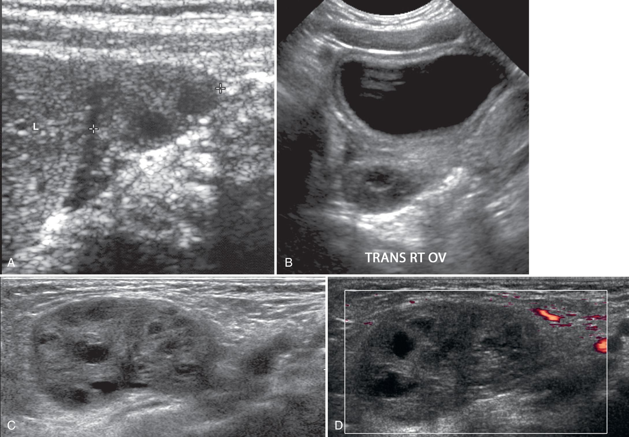 FIG. 54.8, Ectopic Ovary.