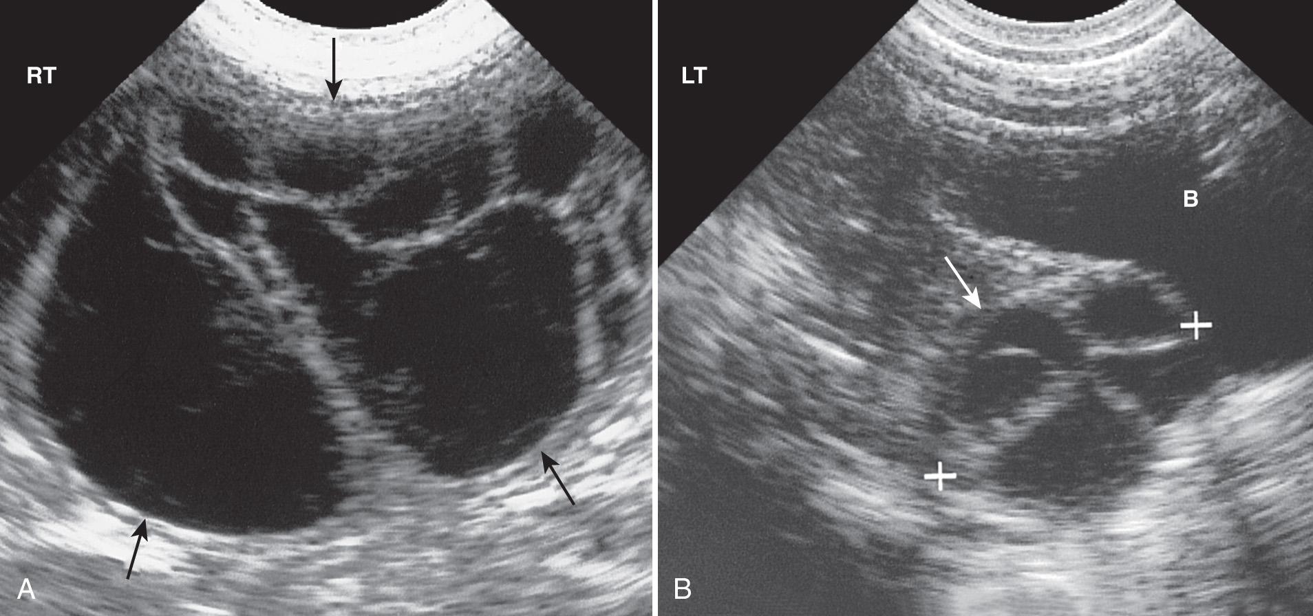 FIG. 54.9, Ovarian Cysts in Newborn Girl.