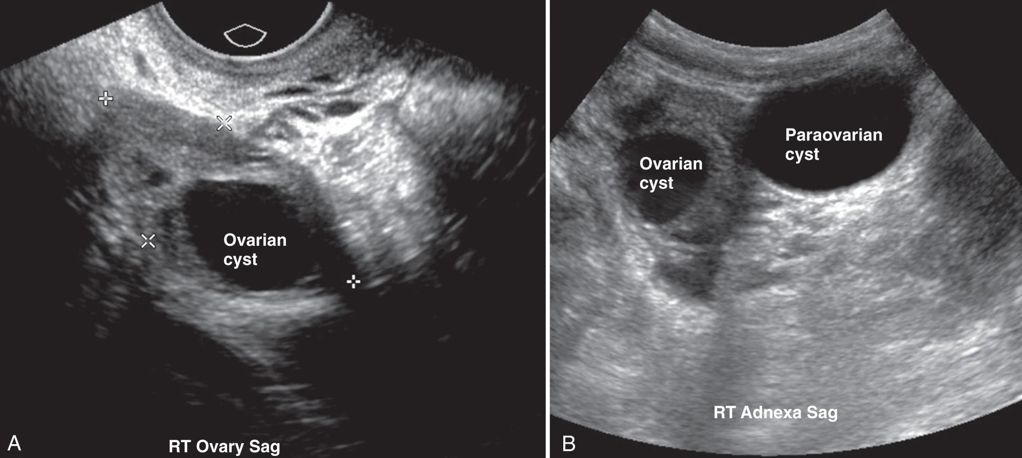 FIG. 54.10, Adnexal Cysts in Teenager.