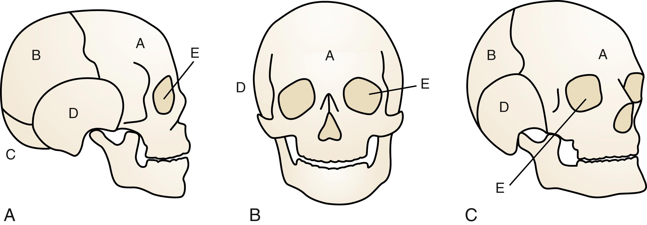 Fig. 23.1, Bones of the human skull in lateral (A), anteroposterior (B), and oblique (C) presentation. A, Frontal; B, parietal; C, occipital; D, temporal; E, ethmoid.