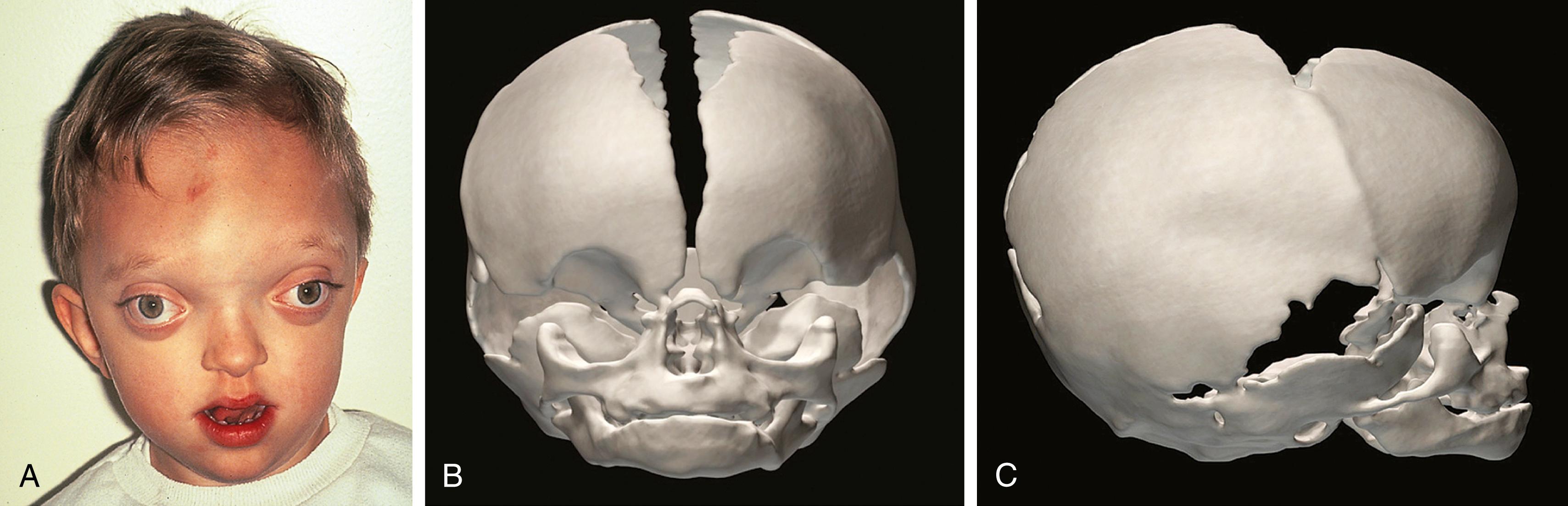 Fig. 23.11, Crouzon syndrome. (A) Frontal view; (B) anterior skeletal view; (C) lateral skeletal view.